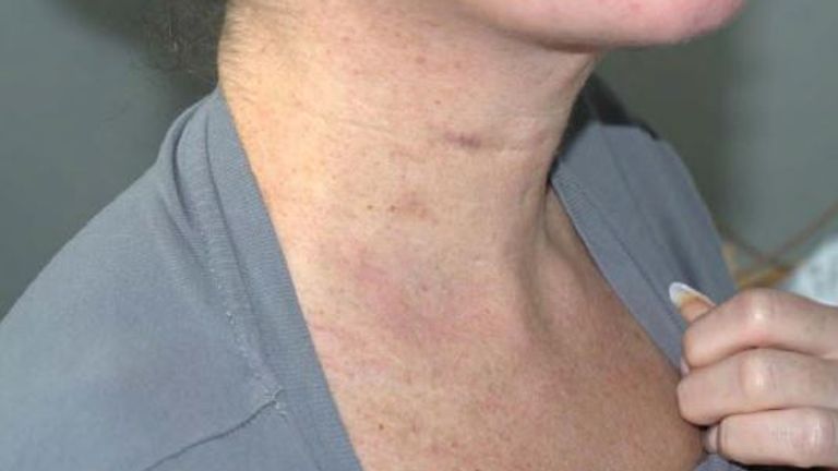 Injuries to Kerry's chest. Pic: CPS