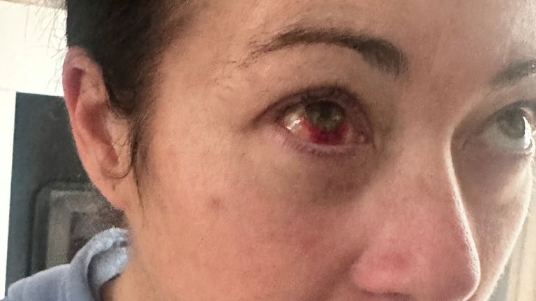 Bleeding in Kerry's eye
