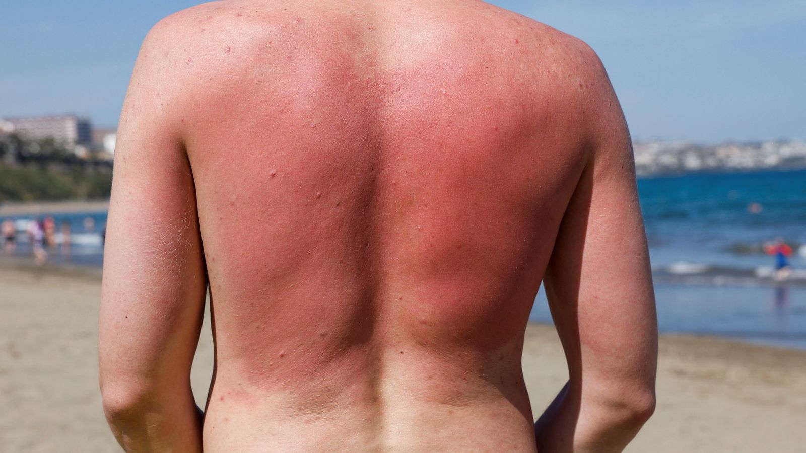 Sunburn isn't just red skin - here's what's happening underneath the burn