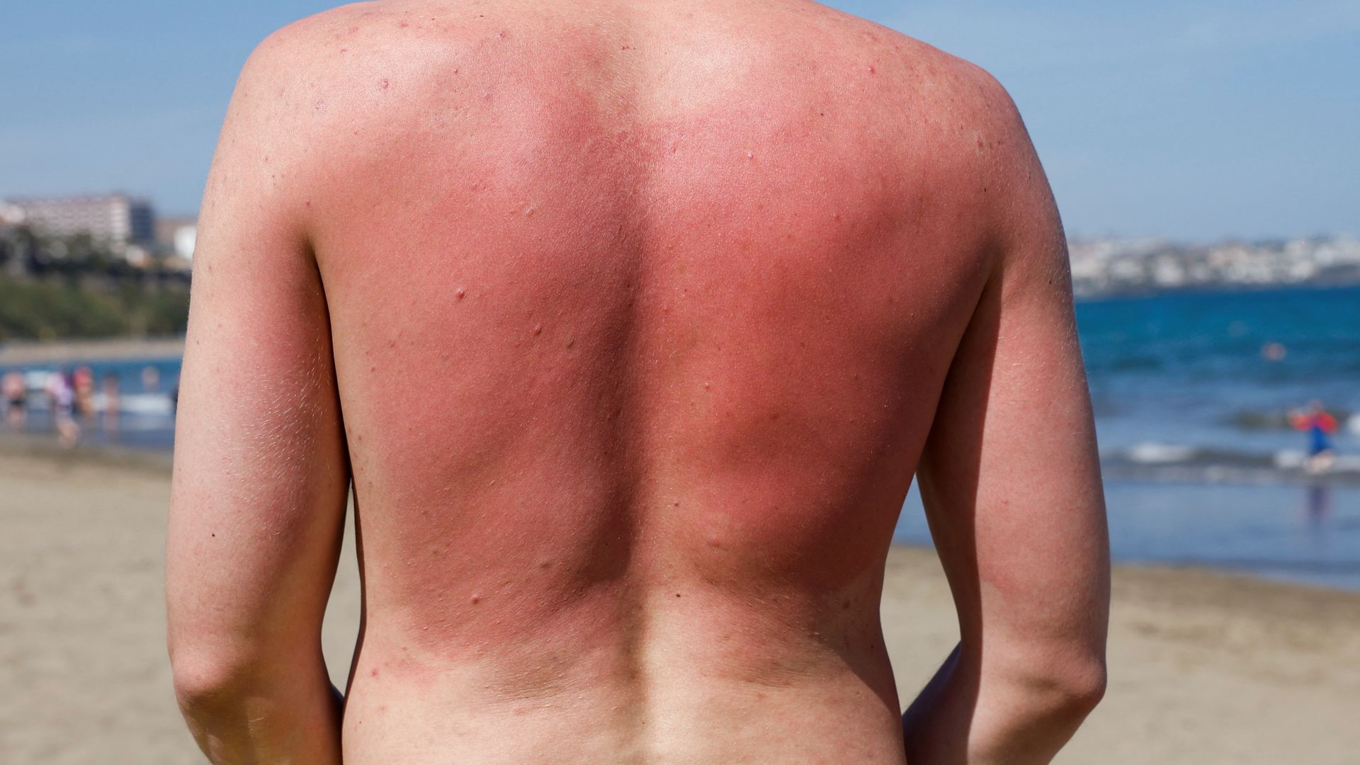 Sunburn isn't just red skin - here's what's happening underneath the burn