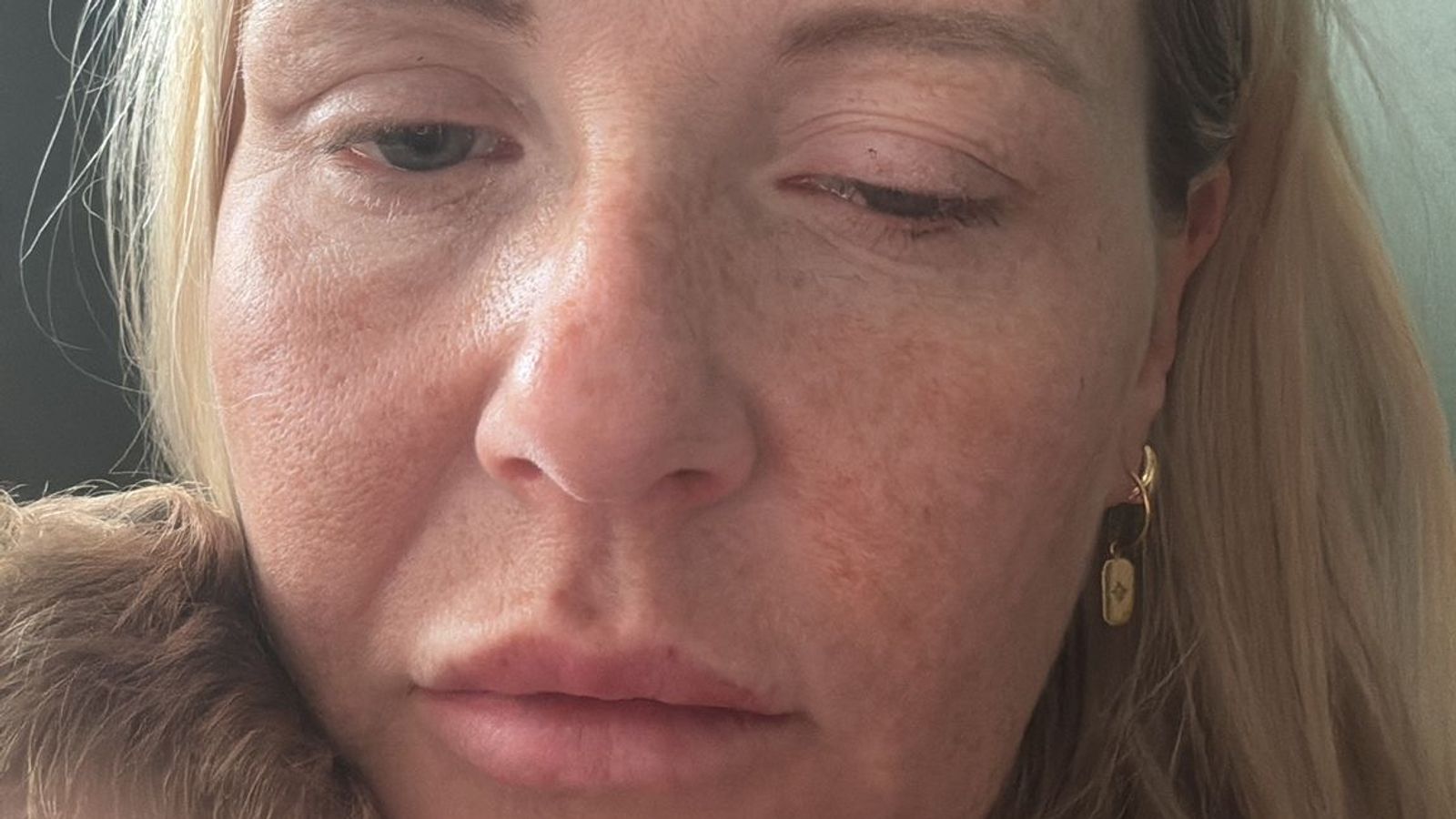'It's the Wild West': Dozens of women develop botulism linked to anti-wrinkle injections 