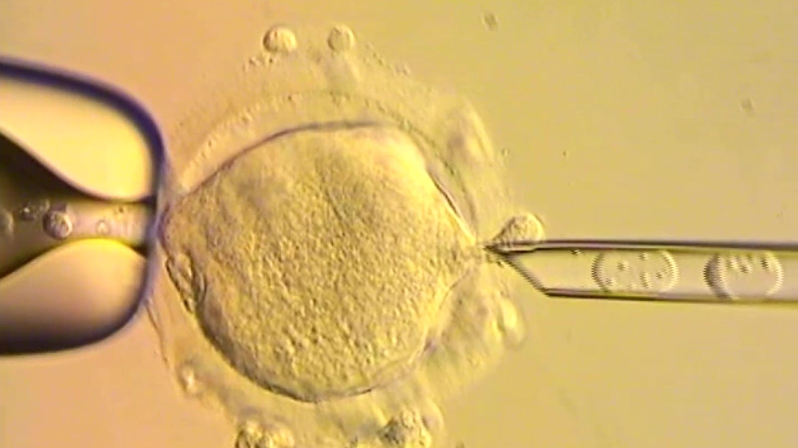 Babies born with DNA from three people in the UK - to prevent 'devastating' illness with no cure