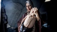 Muhammad Zakariya Ayyoub al-Matouq faces life-threatening malnutrition.
Pic: Anadolu /Getty Images