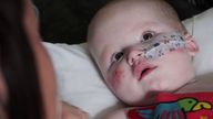 Chester is nearly one now, but needs a ventilator at night to breathe