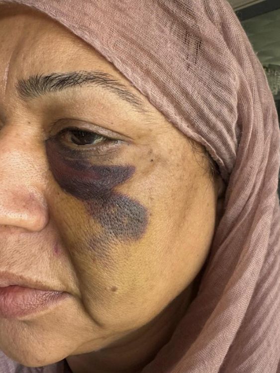picture showing an injury allegedly received by Shameem Akhtar, 56, during an incident at Manchester Airport