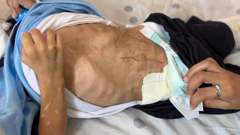 Medical staff reassembled Amir's intestines
