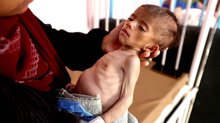 A Palestinian woman holds her 5-month-old daughter, Wateen Abu Amoua  at Nasser Hospital in Khan Younis.
Pic: Reuters