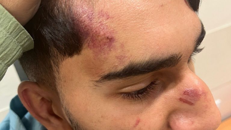 Head injuries received by Mohammed Fahir Amaaz after an alleged assault on three police officers at Manchester Airport last July. Pic: PA