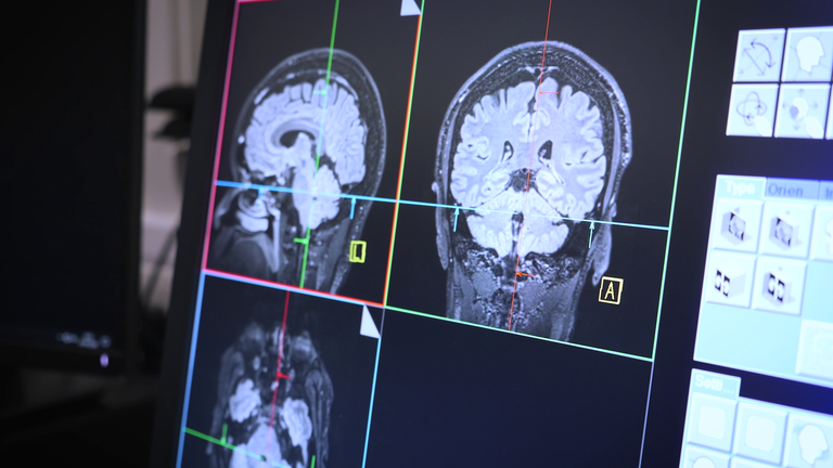 MRI-hersenscans van het UK Biobank-project