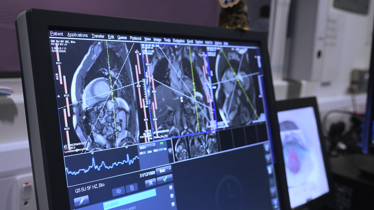 MRI-scans van het UK Biobank-project