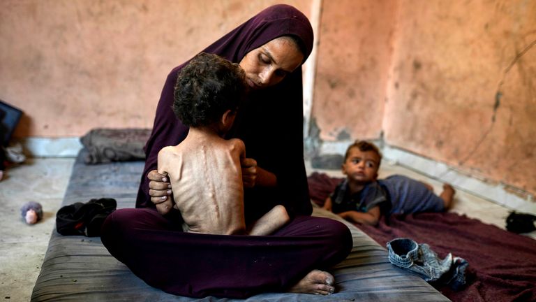 Naima Abu Ful holds her malnourished 2-year-old child, Yazan, at their home in the Shati refugee camp in Gaza City on Wednesday, July 23, 2025. (AP Photo/Jehad Alshrafi)