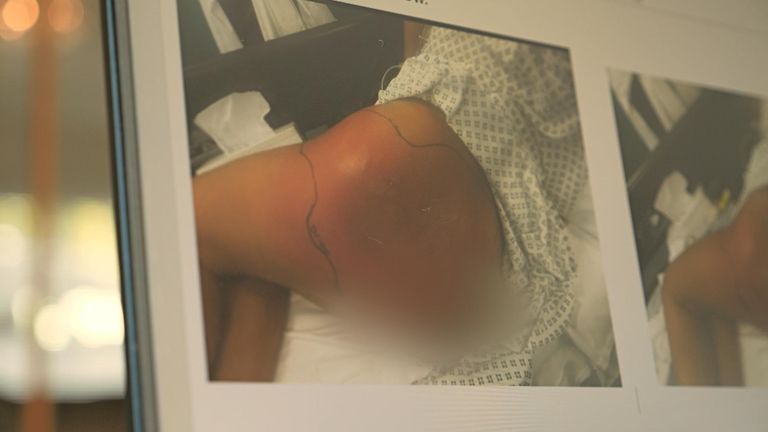 Louise, prosedürün ardından sepsis geliştirdi