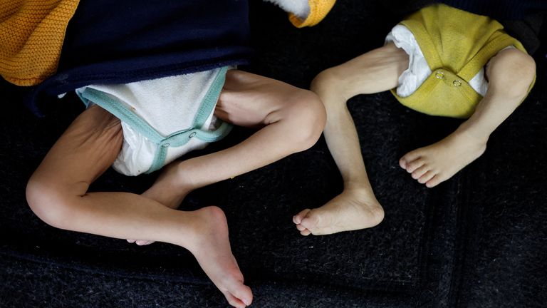 The legs of two malnourished children in a hospital in Rafah. Pic: Reuters