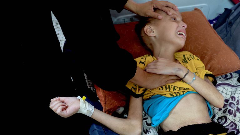 W sierpniu Huda otrzymuje leczenie na oddziale dla niedożywienia szpitala Nasser. Fot: Reuters