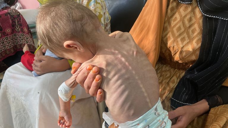 Baby Asma is malnourished 