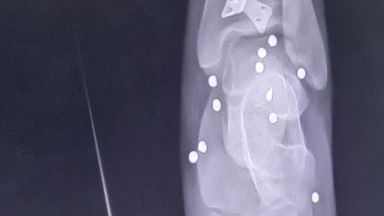The photo shows an X-ray of an injured protester
