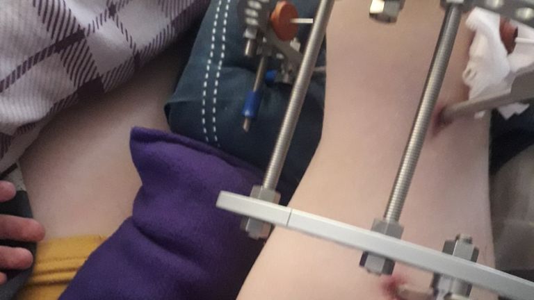 Mr Wood had a frame fixed to his thigh Pic: Family Handout/PA 