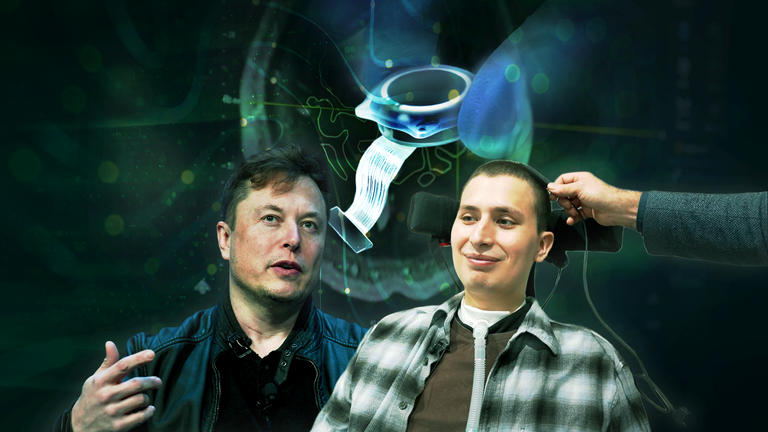 Inside the UK Neuralink brain chip trial. 