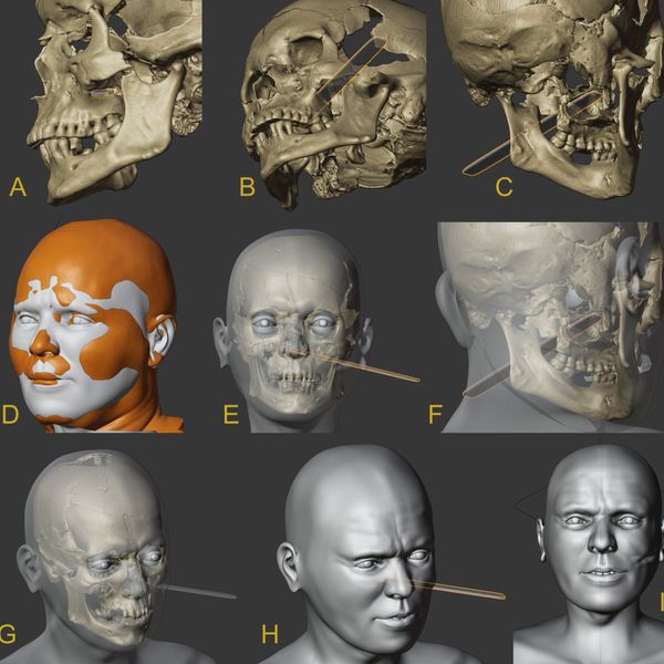 skynews-racesa-vampire-facial-reconstruction_7154010.jpg?20260203070955