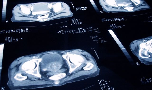 Cancer death rates fall to historic low - as types with biggest drop in fatalities revealed