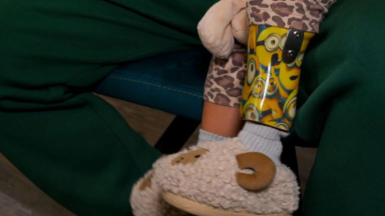 Şarapnel parçasının isabet ettiği Liza'nın sol bacağı kesildi