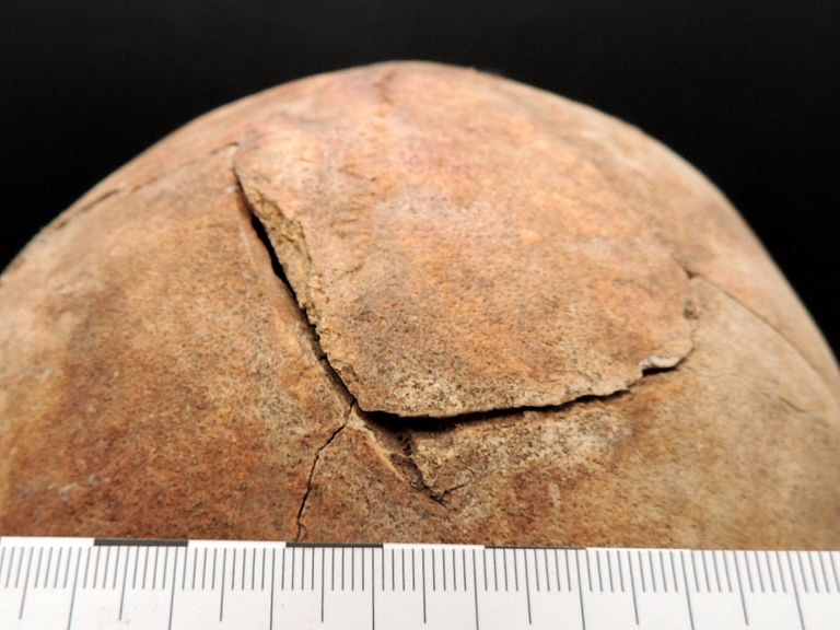 De dodelijke hoofdwond die de Racesa 'vampier' doodde. Foto: Natasa Sarkic