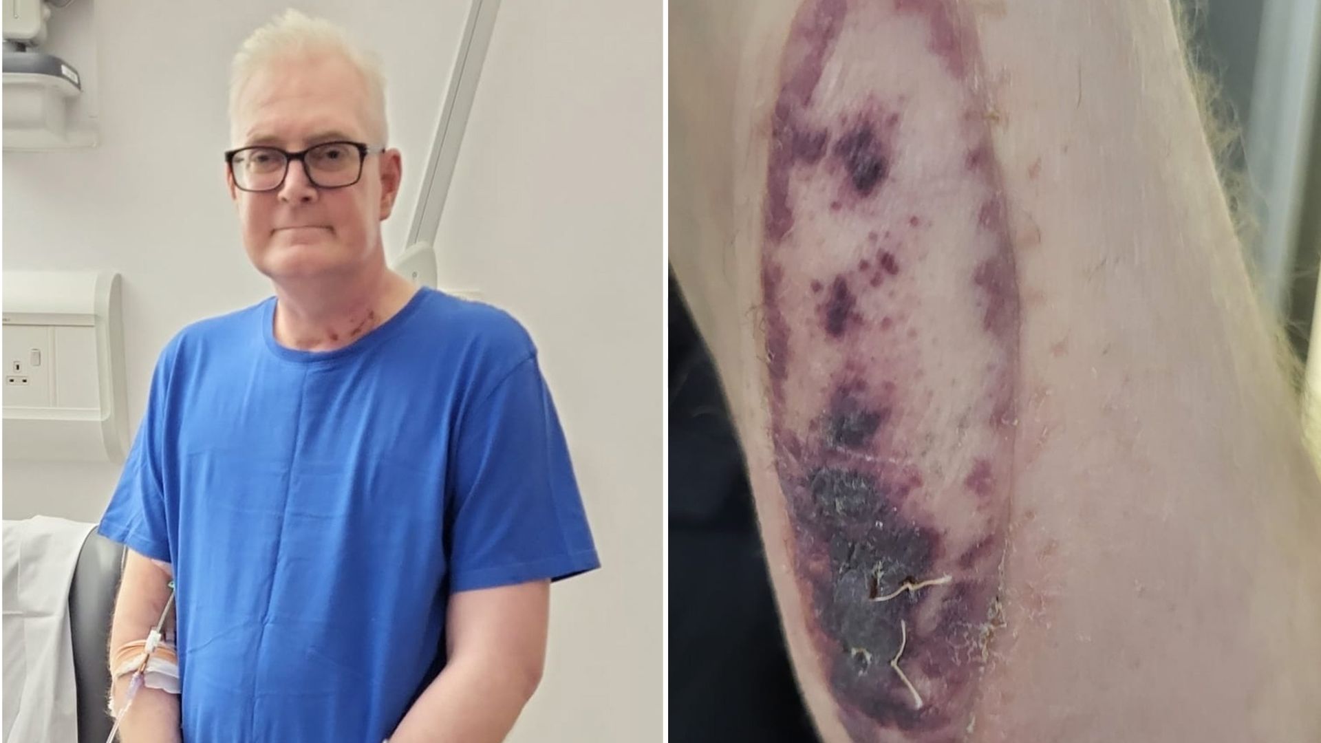 Organ donor's skin patch helped patient discover new lung was being rejected