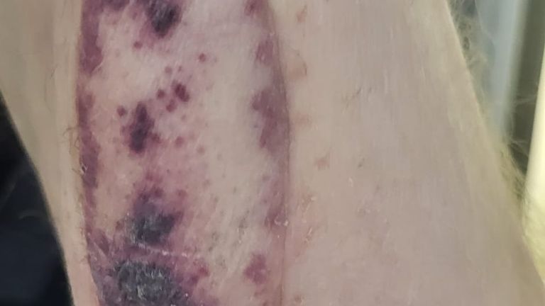 Bay White'ın ön koluna aşılanmış deri yaması. Resim: PA