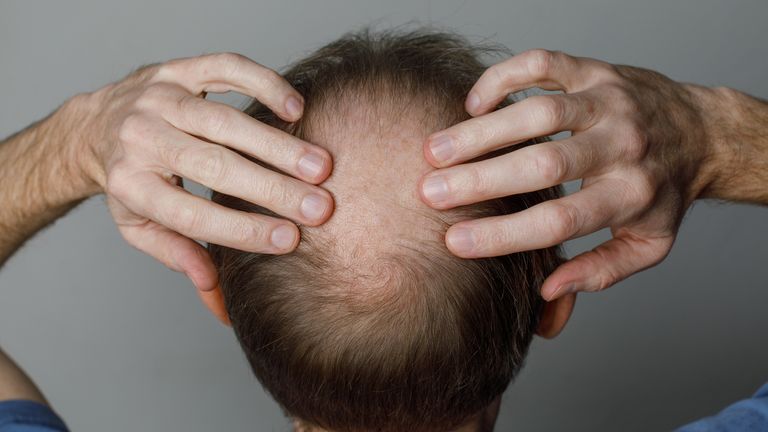 glp-1 hair loss news Does Cause Loss? Treatment For Hair Due to GLP-1 GLP-1 Weight Loss Injections and