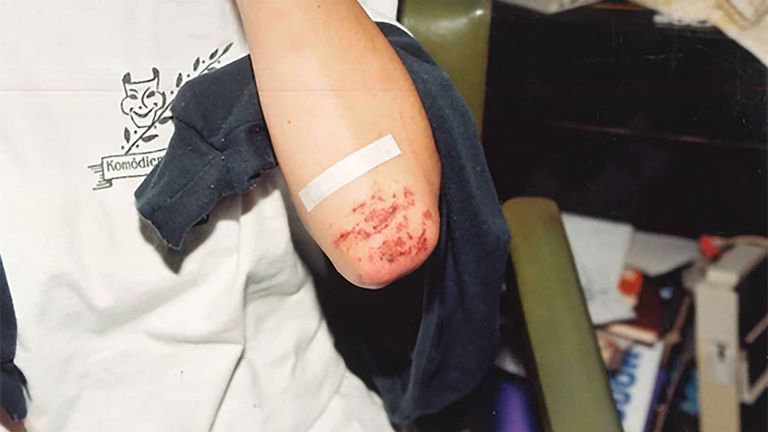 Injuries to Joanne Lees' left arm. Pic: NT police