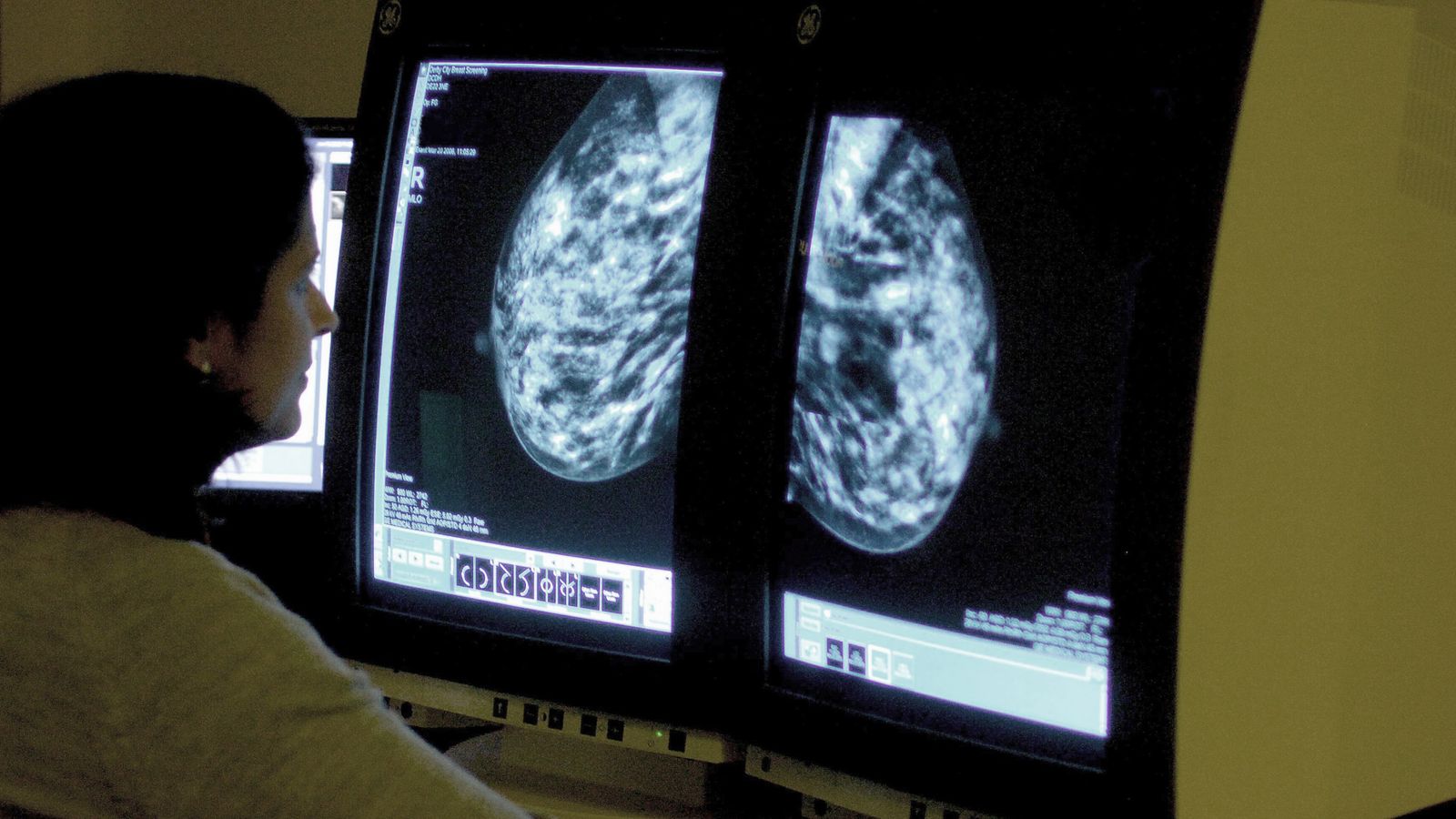 'Concerning' rise in cancer cases among adults under 50